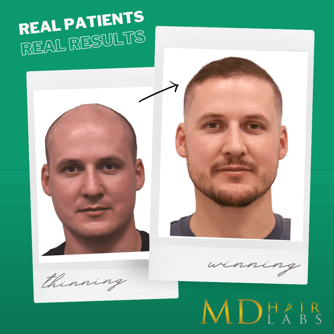Before & After Hair Transplant Artas hair transplant