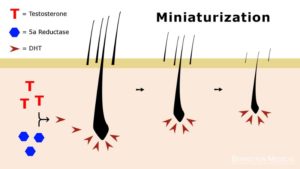 hair miniaturization in men