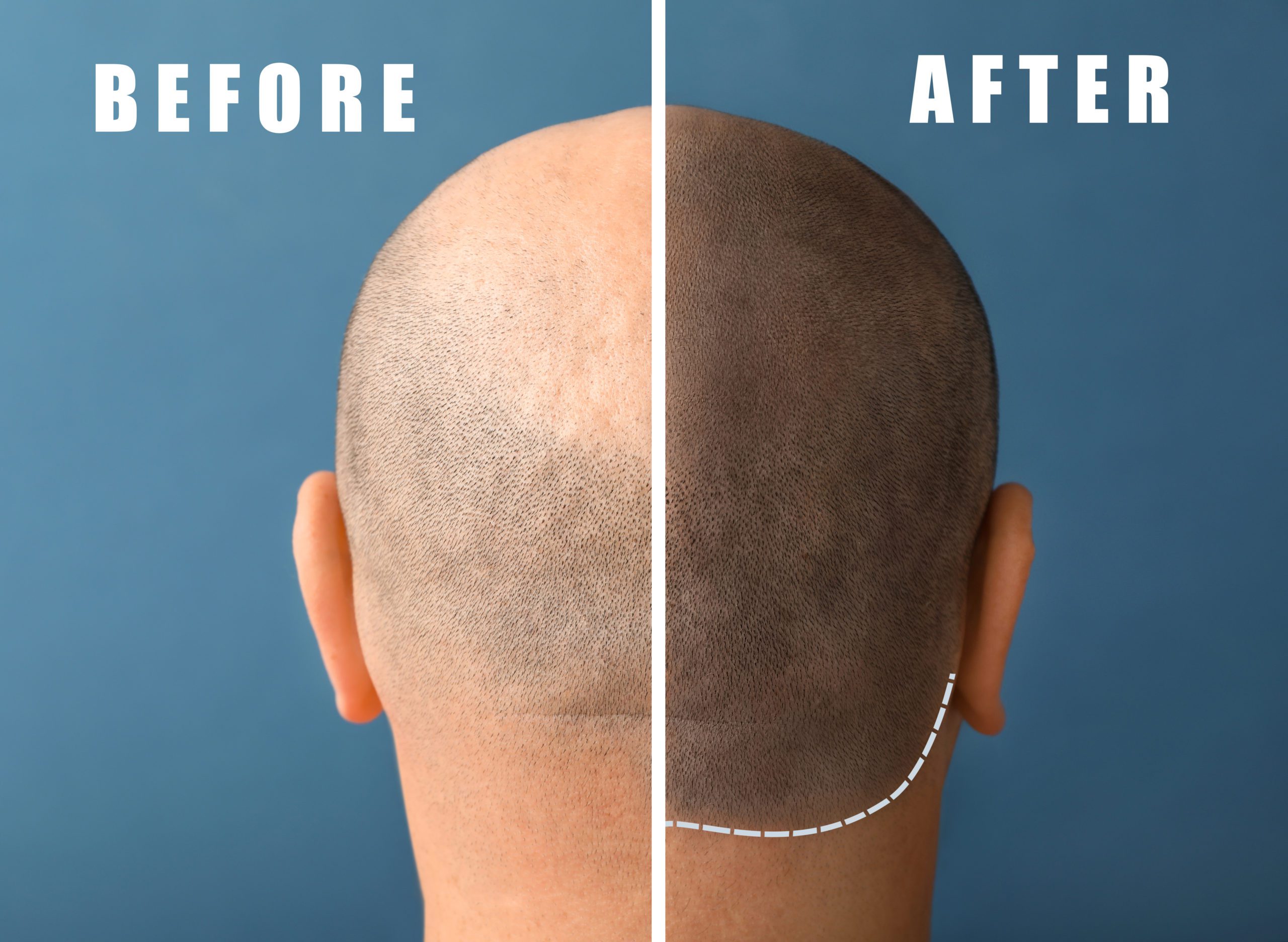Man before and after hair loss treatment on color background Medical-Management-Red-Light-Therapy-Helmet