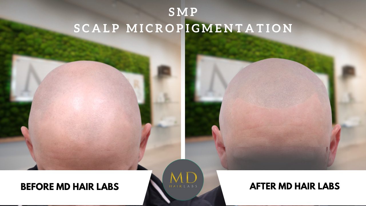 SMP Men Before and After SMP Treatment for Man Before and After