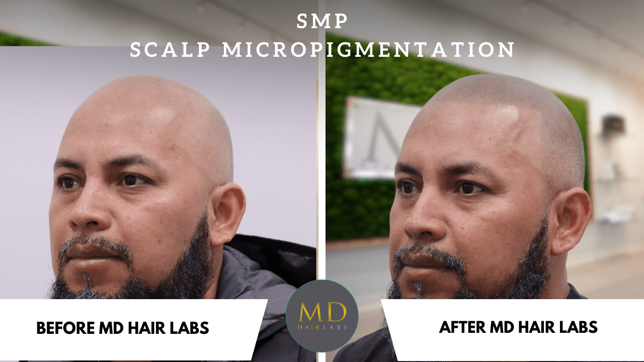SMP Scalp MicroPigmentation