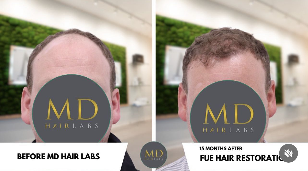 FUE Results